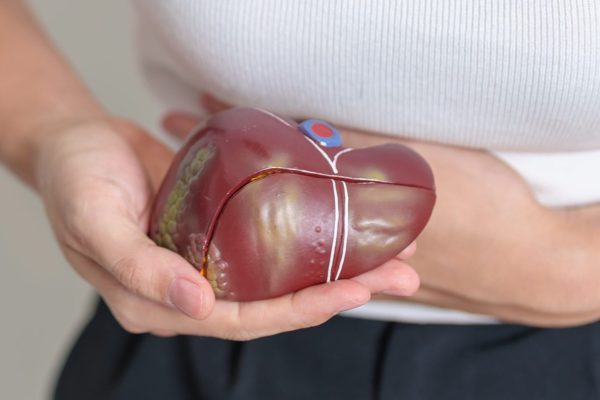 Non Alcoholic Fatty Liver Disease